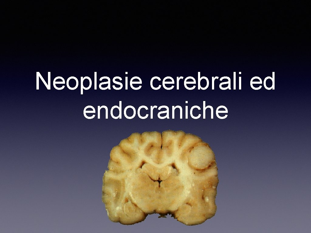 Neoplasie cerebrali ed endocraniche 