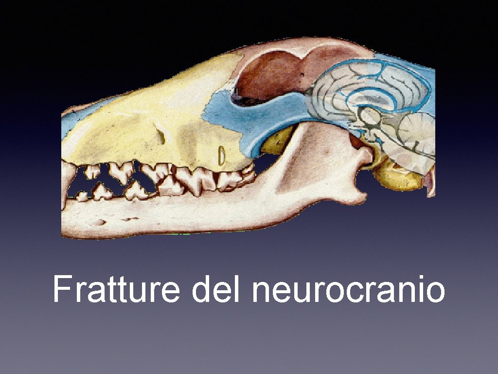 Fratture del neurocranio 