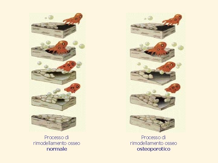 Processo di rimodellamento osseo normale Processo di rimodellamento osseo osteoporotico 