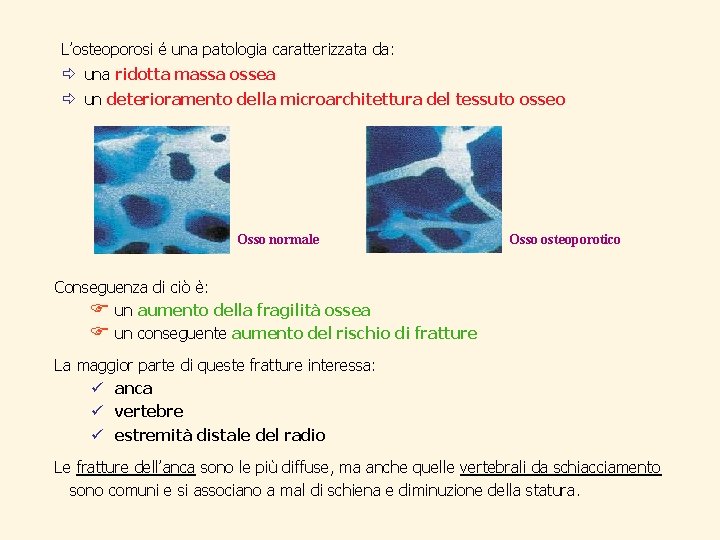 L’osteoporosi é una patologia caratterizzata da: ð una ridotta massa ossea ð un deterioramento