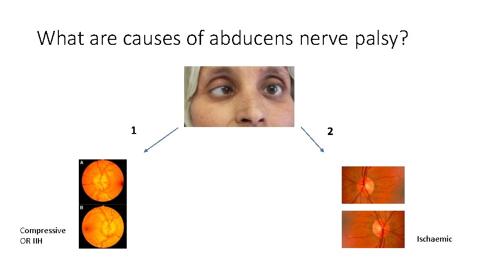 What are causes of abducens nerve palsy? 1 Compressive OR IIH 2 Ischaemic What are causes of abducens nerve palsy? 1 Compressive OR IIH 2 Ischaemic