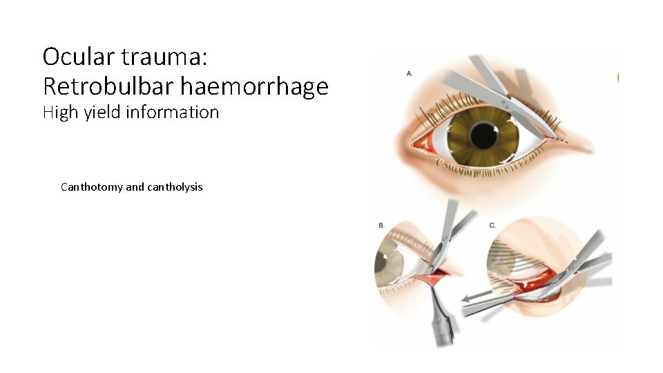 Ocular trauma: Retrobulbar haemorrhage High yield information Canthotomy and cantholysis Ocular trauma: Retrobulbar haemorrhage High yield information Canthotomy and cantholysis