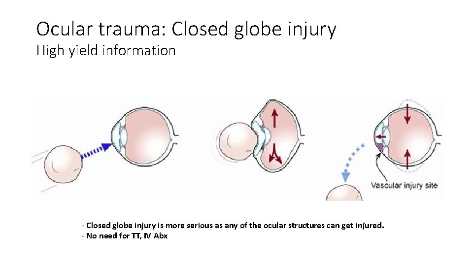 Ocular trauma: Closed globe injury High yield information - Closed globe injury is more Ocular trauma: Closed globe injury High yield information - Closed globe injury is more