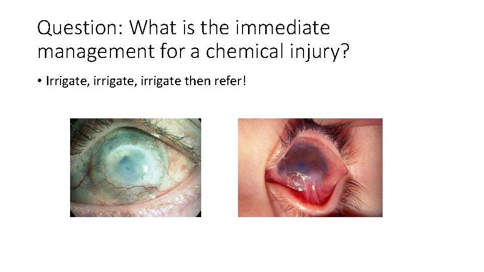 Question: What is the immediate management for a chemical injury? • Irrigate, irrigate then Question: What is the immediate management for a chemical injury? • Irrigate, irrigate then