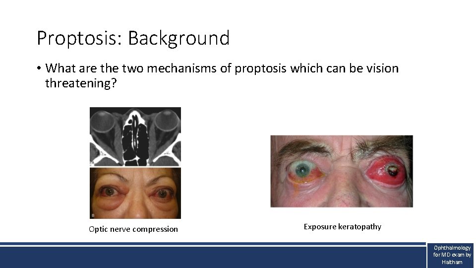 Proptosis: Background • What are the two mechanisms of proptosis which can be vision Proptosis: Background • What are the two mechanisms of proptosis which can be vision