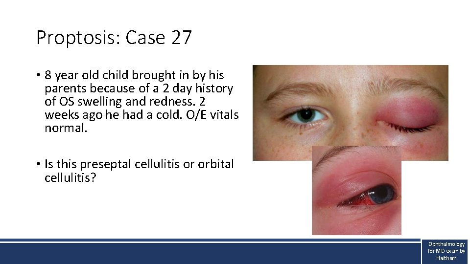 Proptosis: Case 27 • 8 year old child brought in by his parents because Proptosis: Case 27 • 8 year old child brought in by his parents because