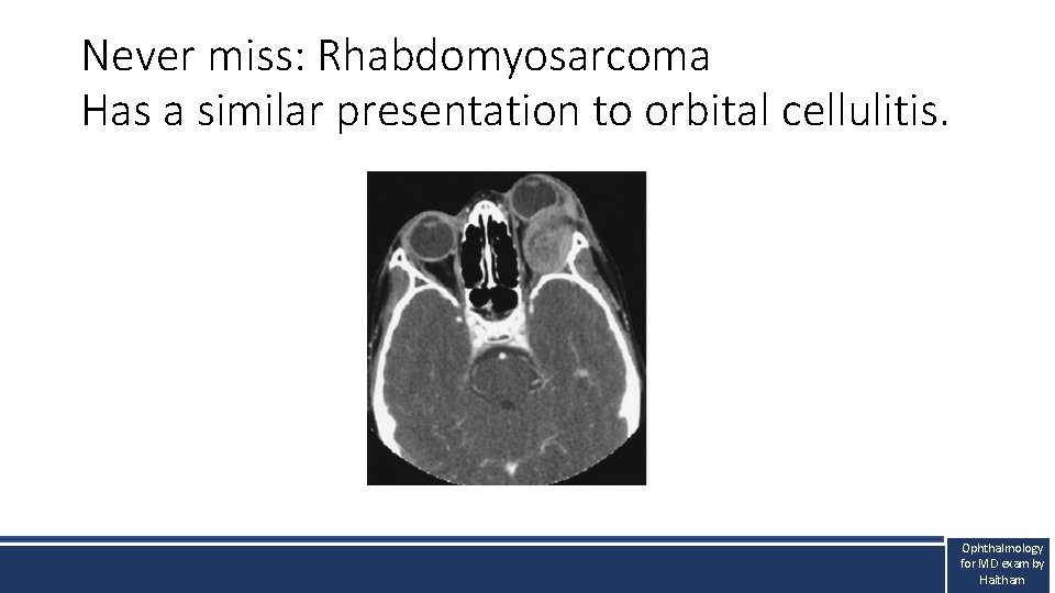 Never miss: Rhabdomyosarcoma Has a similar presentation to orbital cellulitis. Ophthalmology for MD exam Never miss: Rhabdomyosarcoma Has a similar presentation to orbital cellulitis. Ophthalmology for MD exam