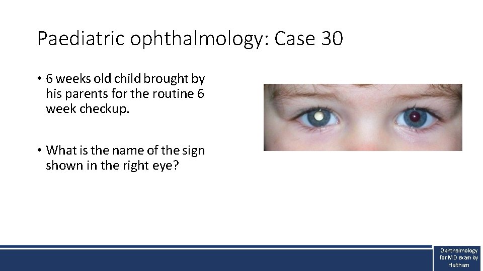 Paediatric ophthalmology: Case 30 • 6 weeks old child brought by his parents for Paediatric ophthalmology: Case 30 • 6 weeks old child brought by his parents for