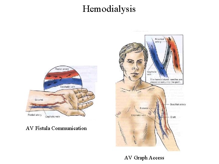 Hemodialysis AV Fistula Communication AV Graph Access 