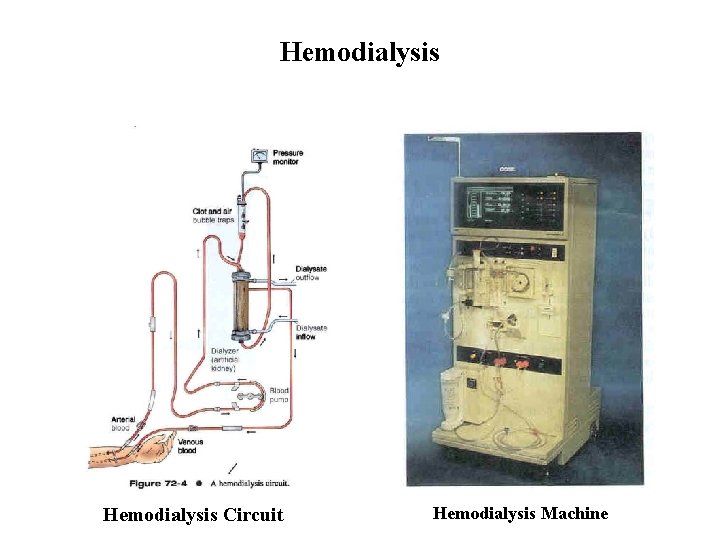 Hemodialysis Circuit Hemodialysis Machine 