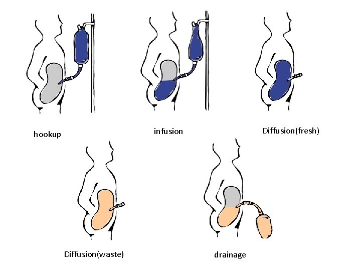 Diffusion(fresh) infusion hookup Diffusion(waste) drainage 