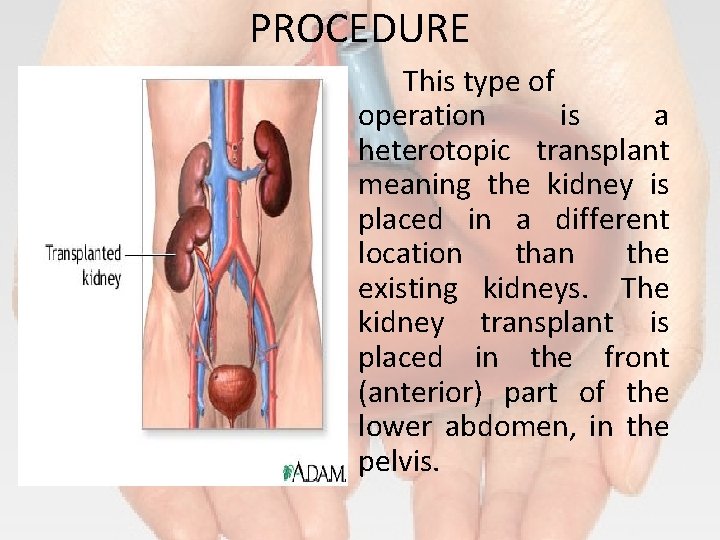 PROCEDURE This type of operation is a heterotopic transplant meaning the kidney is placed