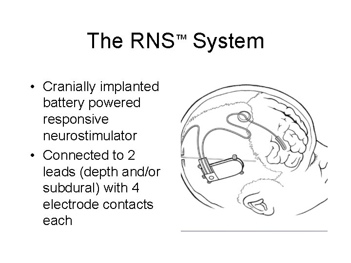 The RNS™ System • Cranially implanted battery powered responsive neurostimulator • Connected to 2