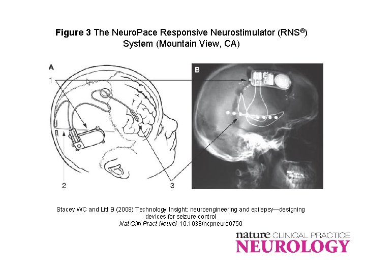 Figure 3 The Neuro. Pace Responsive Neurostimulator (RNS®) System (Mountain View, CA) Stacey WC