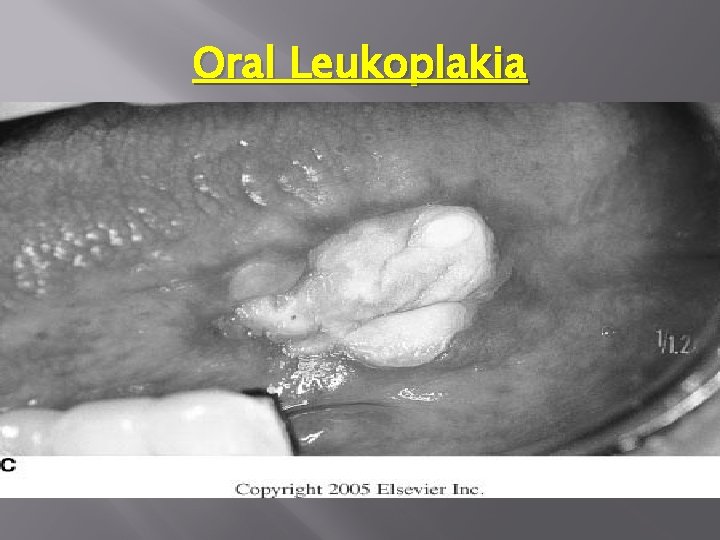 Oral Leukoplakia 