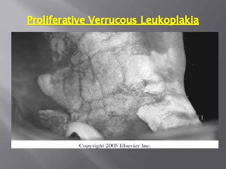 Proliferative Verrucous Leukoplakia 