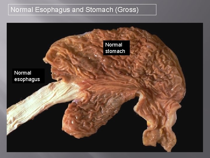 Normal Esophagus and Stomach (Gross) Normal stomach Normal esophagus 