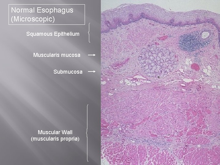 Normal Esophagus (Microscopic) Squamous Epithelium Muscularis mucosa Submucosa Muscular Wall (muscularis propria) 
