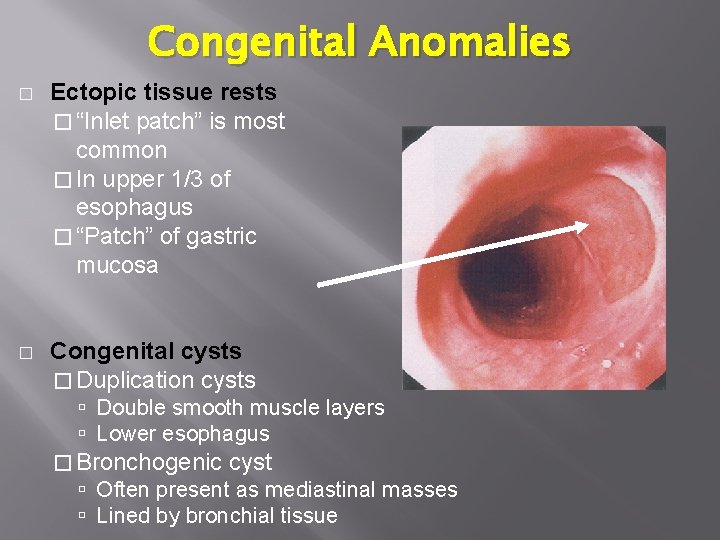 Congenital Anomalies � Ectopic tissue rests � “Inlet patch” is most common � In