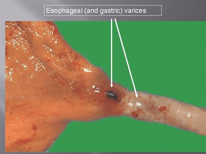 Esophageal (and gastric) varices 