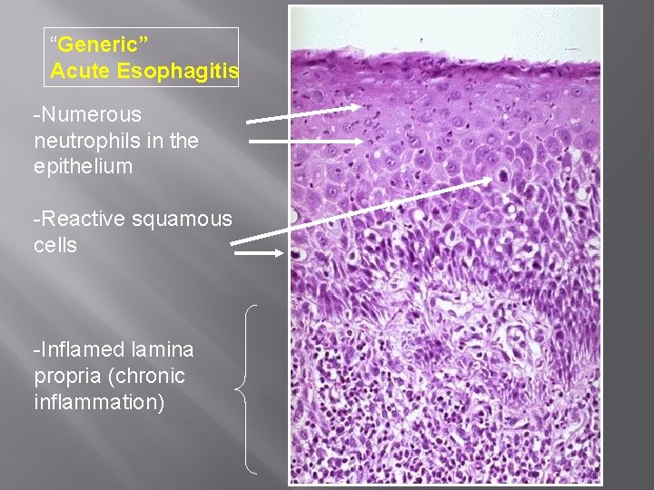 “Generic” Acute Esophagitis -Numerous neutrophils in the epithelium -Reactive squamous cells -Inflamed lamina propria