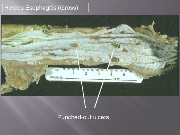 Herpes Esophagitis (Gross) Punched-out ulcers 