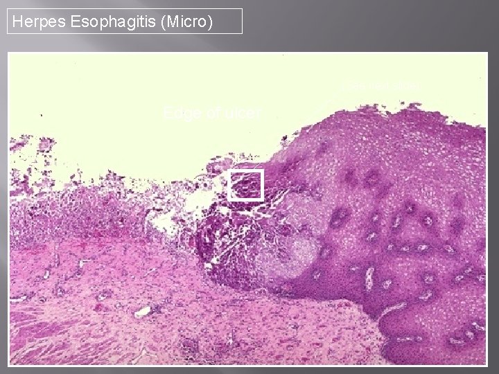 Herpes Esophagitis (Micro) (See next slide) Edge of ulcer 