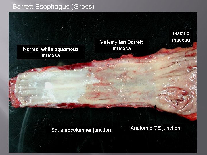 Barrett Esophagus (Gross) Normal white squamous mucosa Velvety tan Barrett mucosa Squamocolumnar junction Gastric