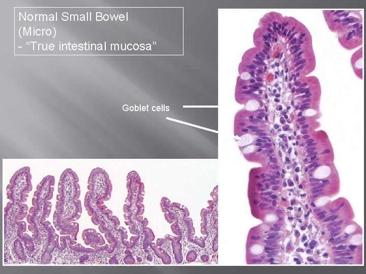 Normal Small Bowel (Micro) - “True intestinal mucosa” Goblet cells 
