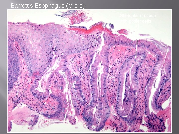 Barrett’s Esophagus (Micro) Squamous mucosa Glandular mucosa with goblet cells 