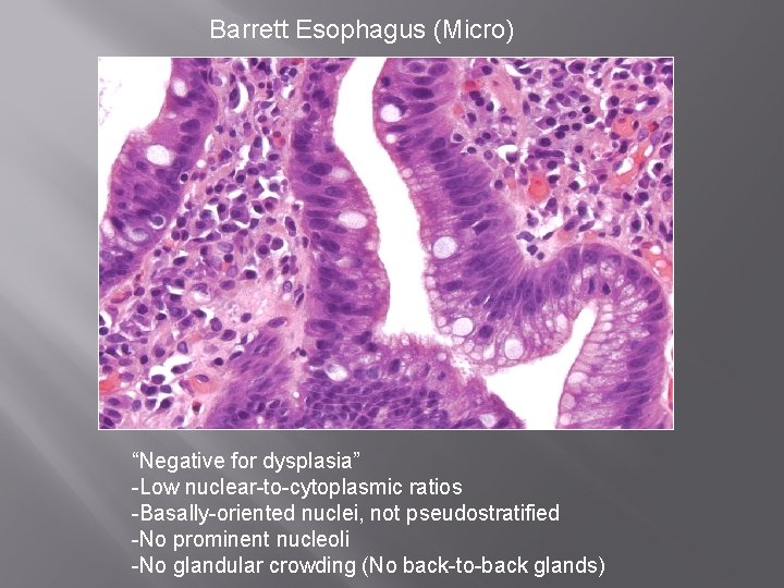 Barrett Esophagus (Micro) “Negative for dysplasia” -Low nuclear-to-cytoplasmic ratios -Basally-oriented nuclei, not pseudostratified -No