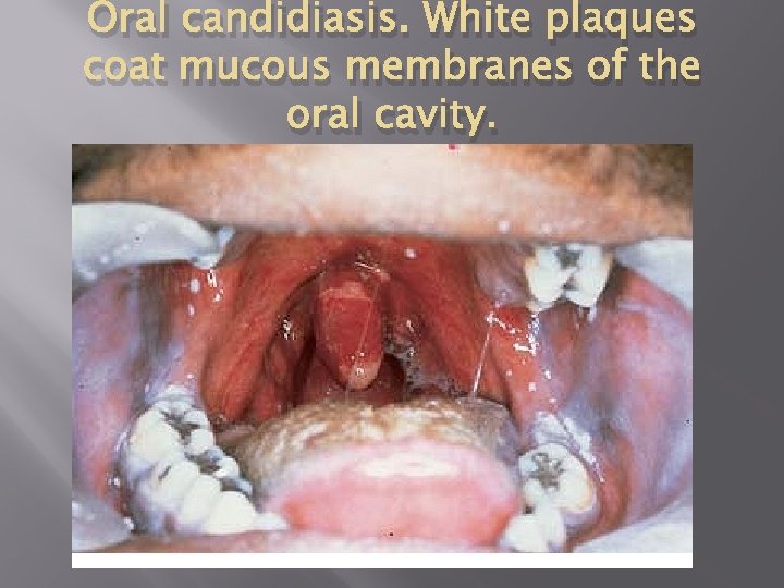 Oral candidiasis. White plaques coat mucous membranes of the oral cavity. 