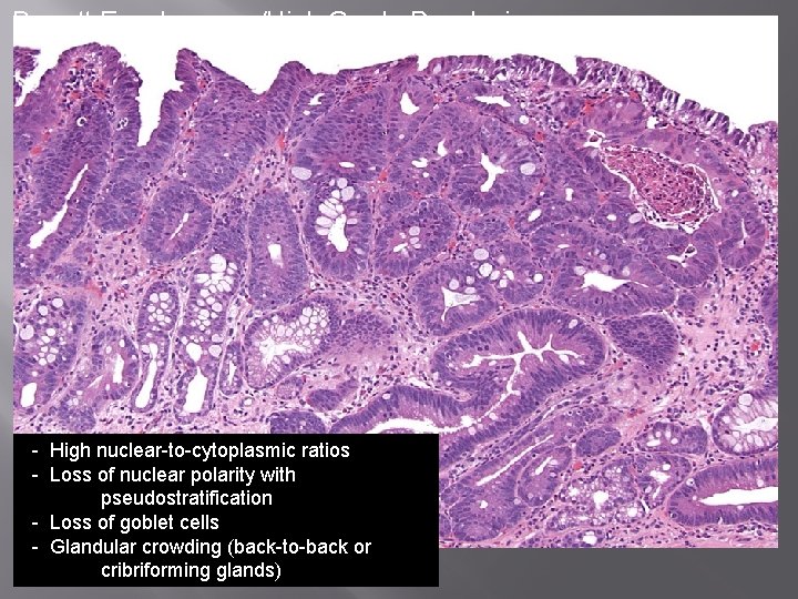 Barrett Esophagus w/High Grade Dysplasia - High nuclear-to-cytoplasmic ratios - Loss of nuclear polarity