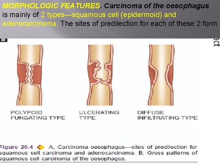 MORPHOLOGIC FEATURES. Carcinoma of the oesophagus is mainly of 2 types—squamous cell (epidermoid) and