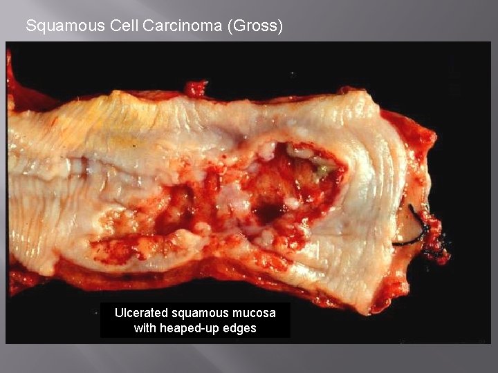 Squamous Cell Carcinoma (Gross) Ulcerated squamous mucosa with heaped-up edges 