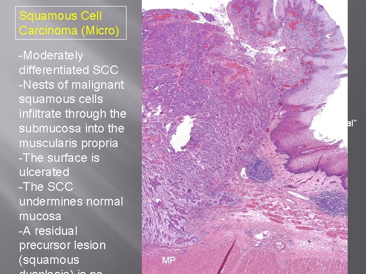 Squamous Cell Carcinoma (Micro) -Moderately differentiated SCC -Nests of malignant squamous cells infiltrate through