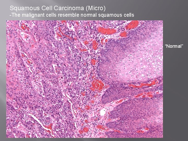 Squamous Cell Carcinoma (Micro) -The malignant cells resemble normal squamous cells “Normal” 