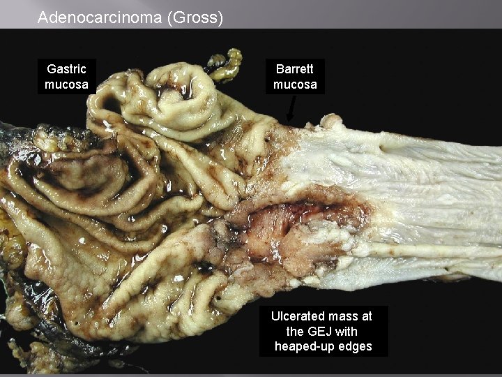 Adenocarcinoma (Gross) Gastric mucosa Barrett mucosa Ulcerated mass at the GEJ with heaped-up edges
