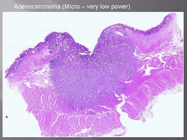 Adenocarcinoma (Micro – very low power) 