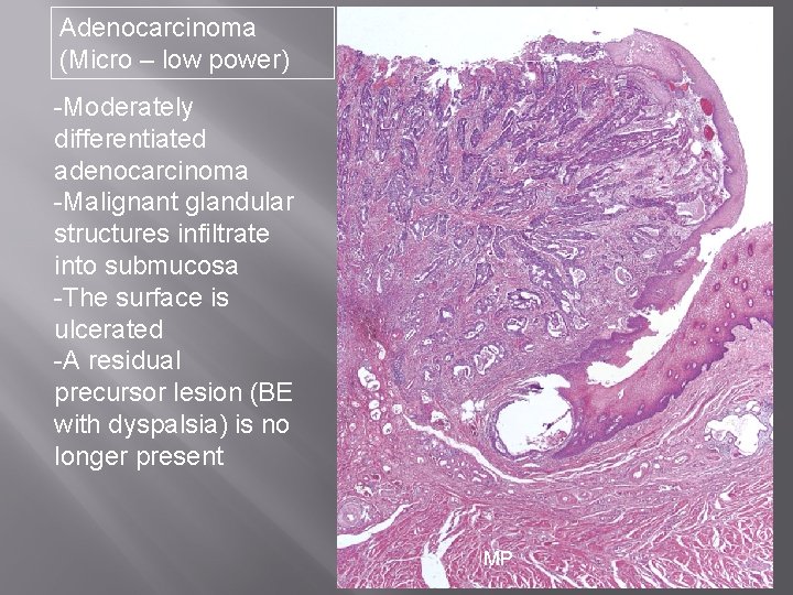 Adenocarcinoma (Micro – low power) “Normal” -Moderately differentiated adenocarcinoma -Malignant glandular structures infiltrate into