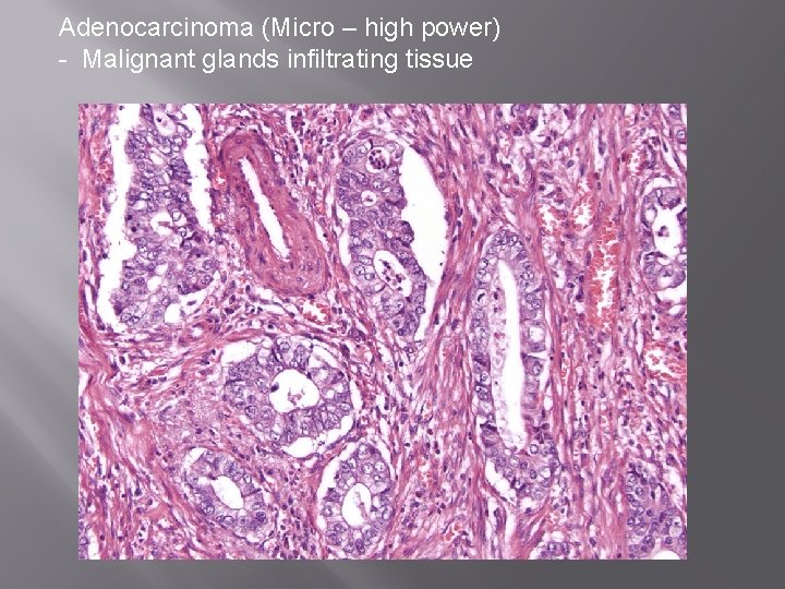 Adenocarcinoma (Micro – high power) - Malignant glands infiltrating tissue 