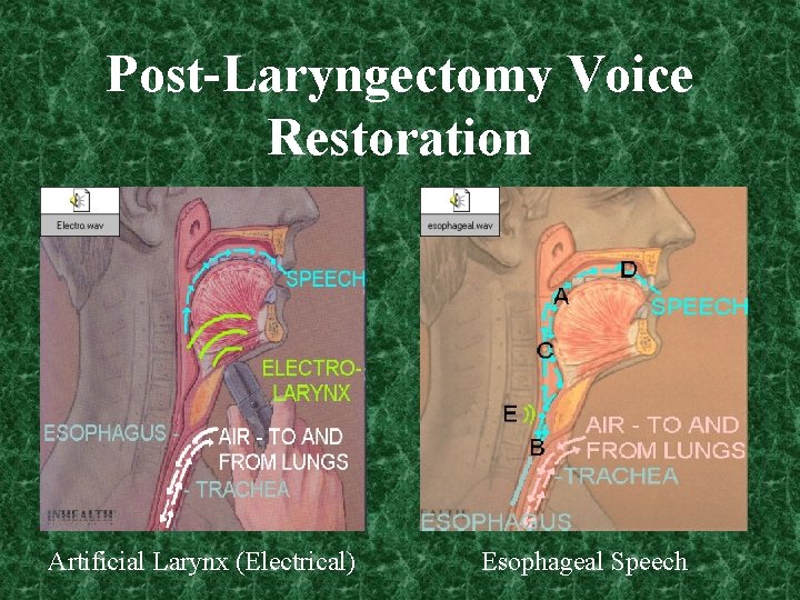 Post-Laryngectomy Voice Restoration Artificial Larynx (Electrical) Esophageal Speech 