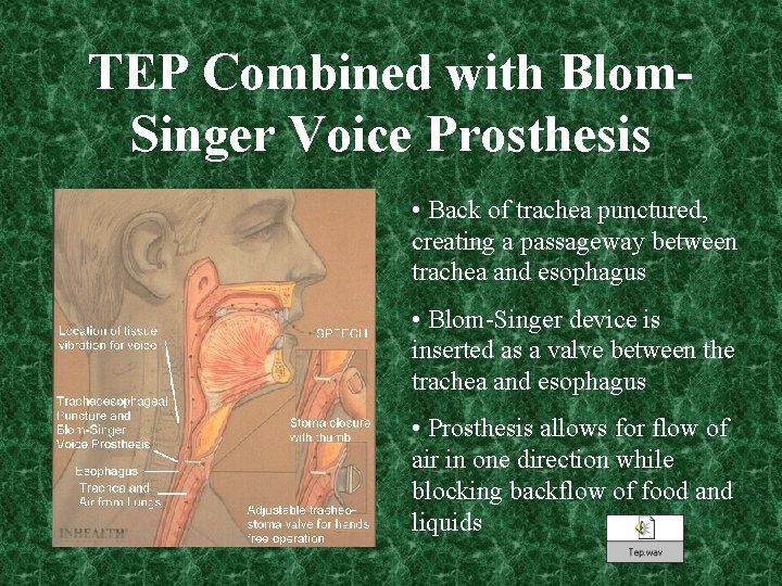 TEP Combined with Blom. Singer Voice Prosthesis • Back of trachea punctured, creating a