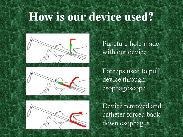 How is our device used? Puncture hole made with our device Forceps used to