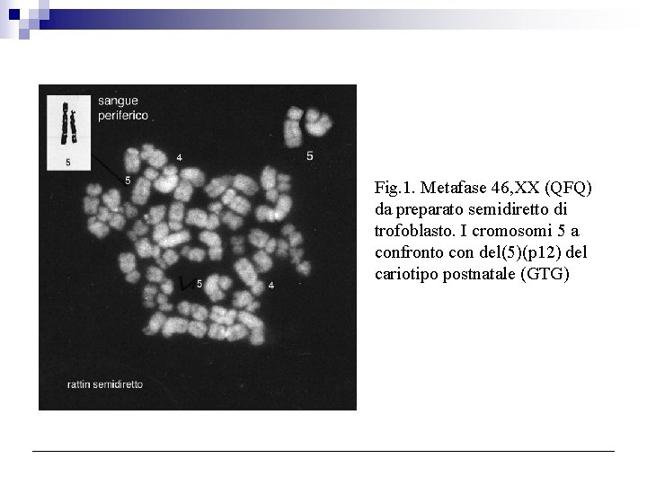 Fig. 1. Metafase 46, XX (QFQ) da preparato semidiretto di trofoblasto. I cromosomi 5