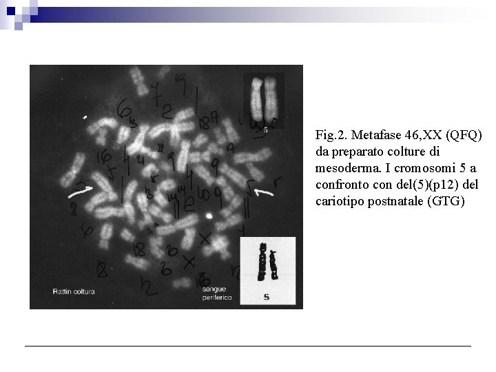 Fig. 2. Metafase 46, XX (QFQ) da preparato colture di mesoderma. I cromosomi 5