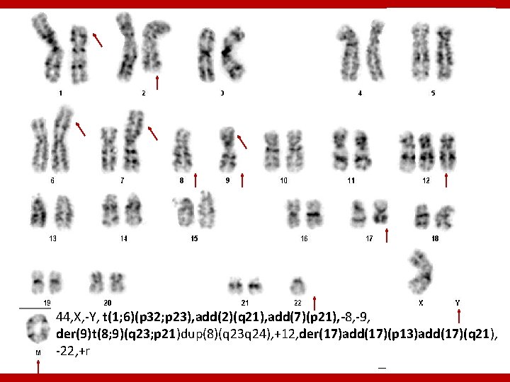 44, X, -Y, t(1; 6)(p 32; p 23), add(2)(q 21), add(7)(p 21), -8, -9,