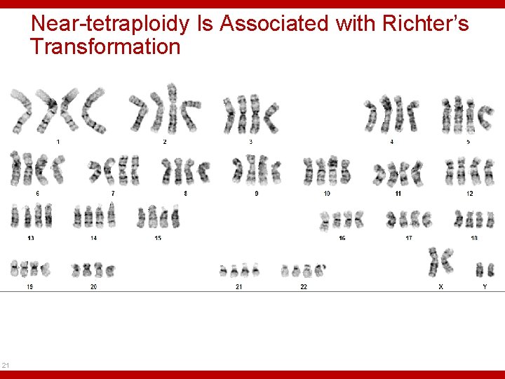 Near-tetraploidy Is Associated with Richter’s Transformation 21 