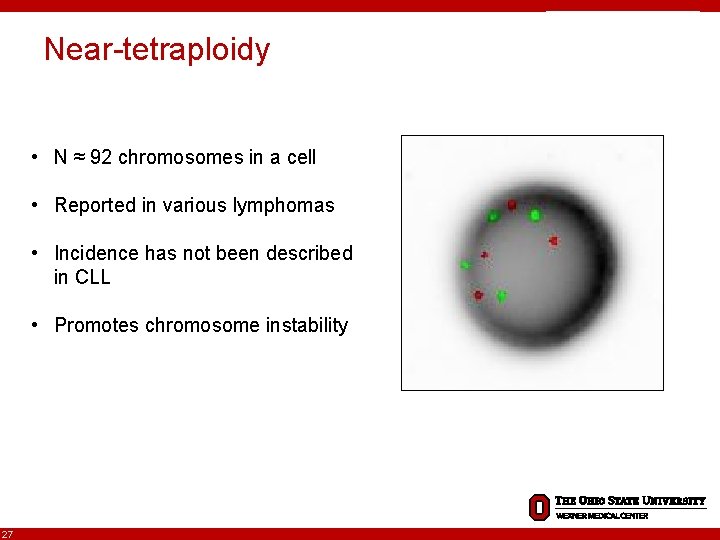 Near-tetraploidy • N ≈ 92 chromosomes in a cell • Reported in various lymphomas