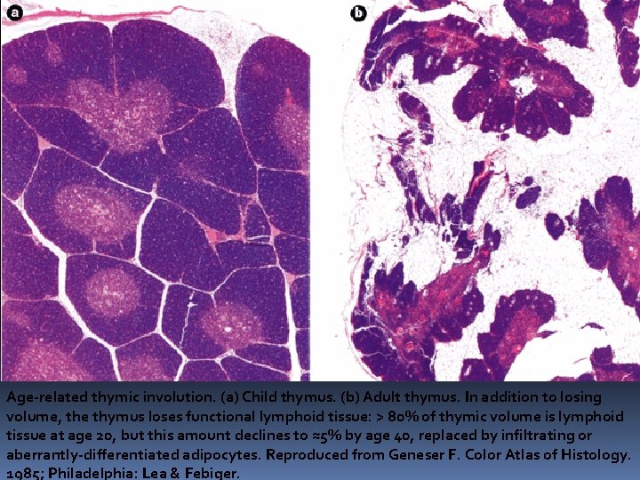 Age-related thymic involution. (a) Child thymus. (b) Adult thymus. In addition to losing volume, Age-related thymic involution. (a) Child thymus. (b) Adult thymus. In addition to losing volume,
